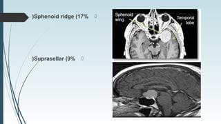 Sphenoid ridge (17%(
Suprasellar (9%(
 