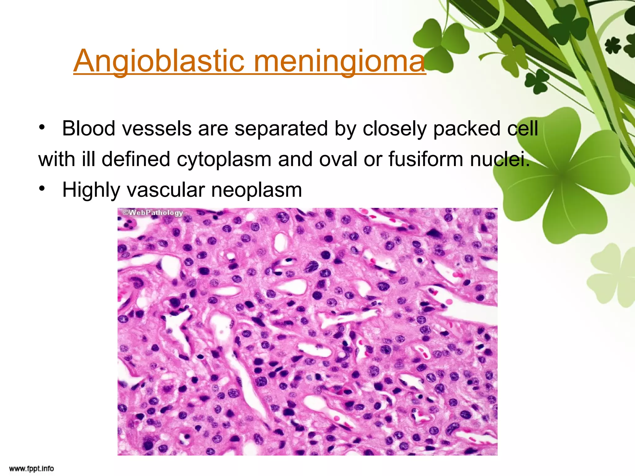 Angioblastic meningioma
• Blood vessels are separated by closely packed cell
with ill defined cytoplasm and oval or fusiform nuclei.
• Highly vascular neoplasm