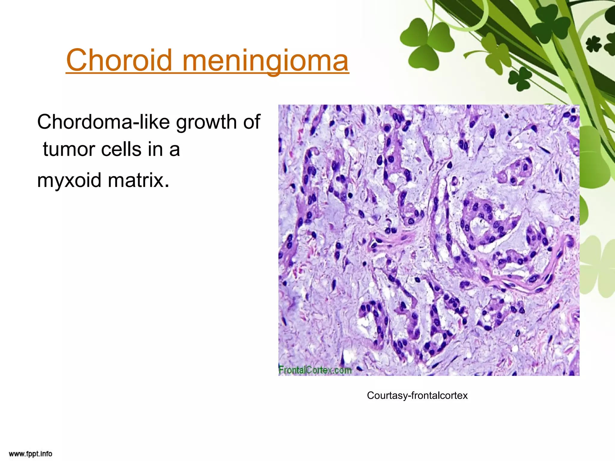 Choroid meningioma
Chordoma-like growth of
tumor cells in a
myxoid matrix.
Courtasy-frontalcortex