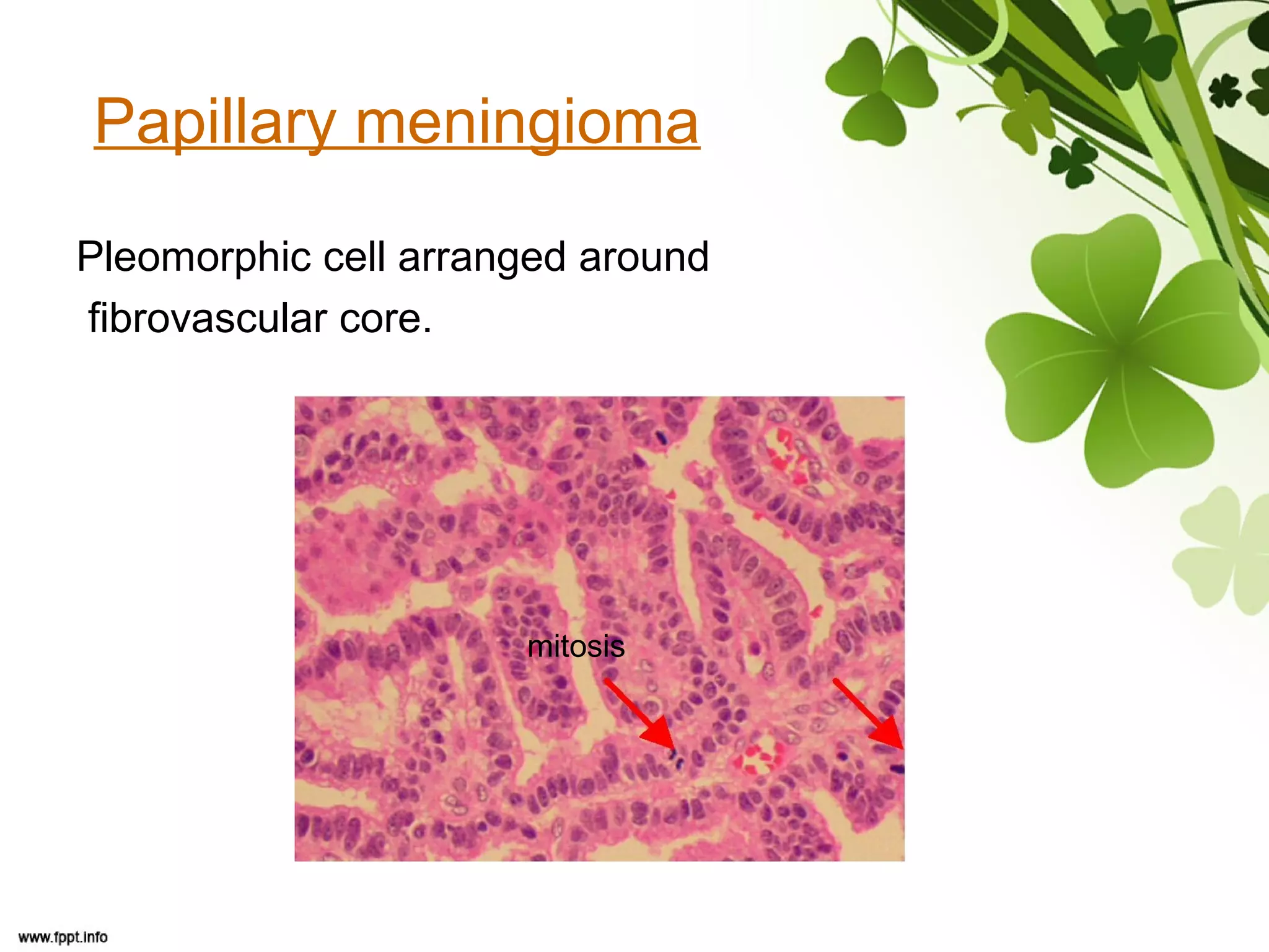 Papillary meningioma
Pleomorphic cell arranged around
fibrovascular core.
mitosis