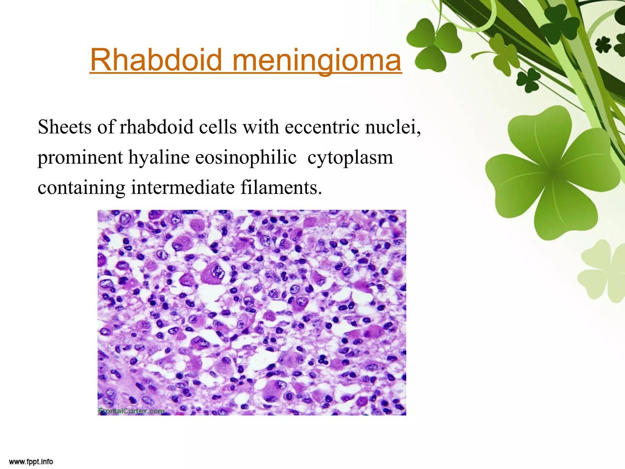 Rhabdoid meningioma
Sheets of rhabdoid cells with eccentric nuclei,
prominent hyaline eosinophilic cytoplasm
containing intermediate filaments.