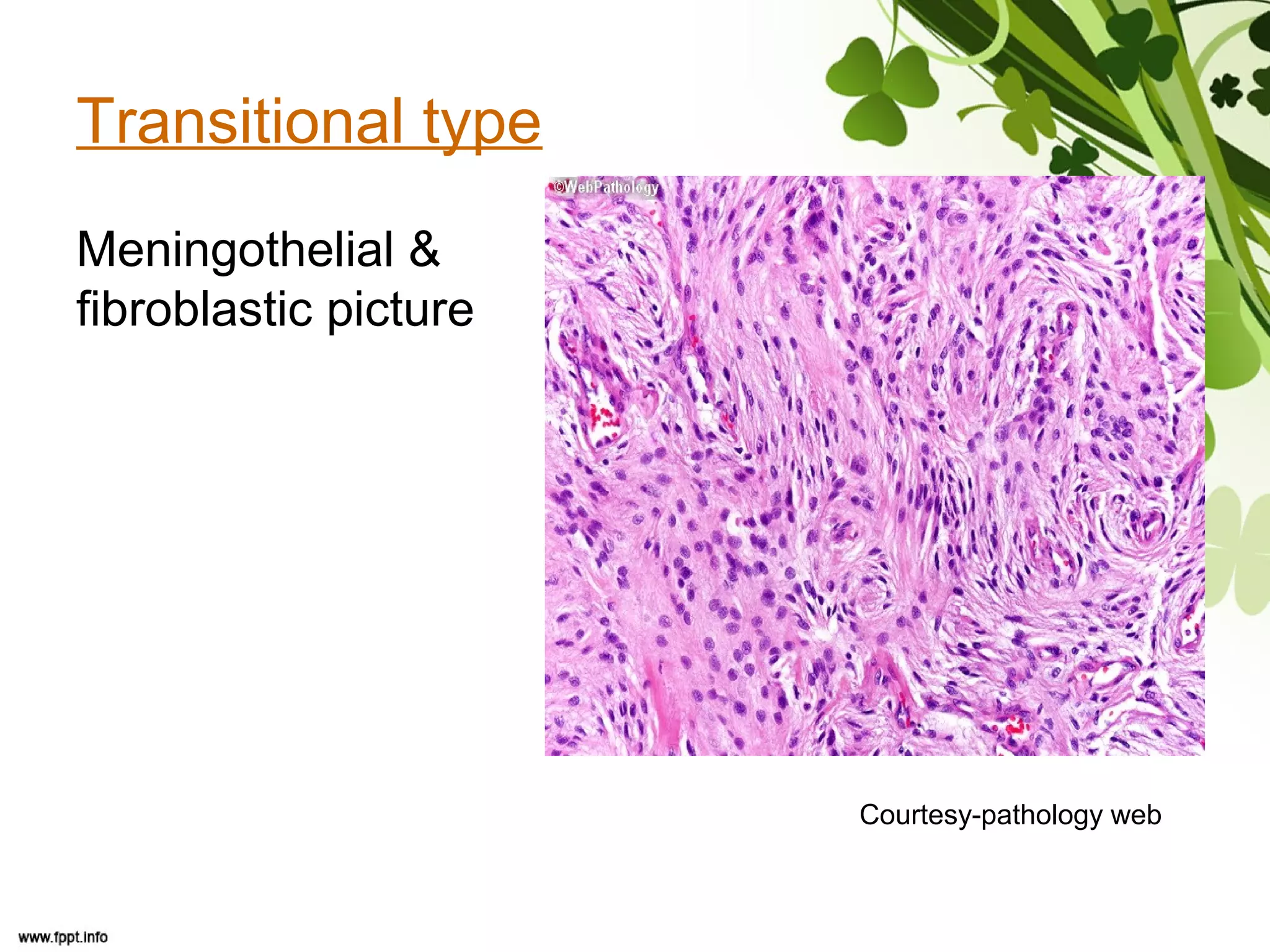Transitional type
Meningothelial &
fibroblastic picture
Courtesy-pathology web
