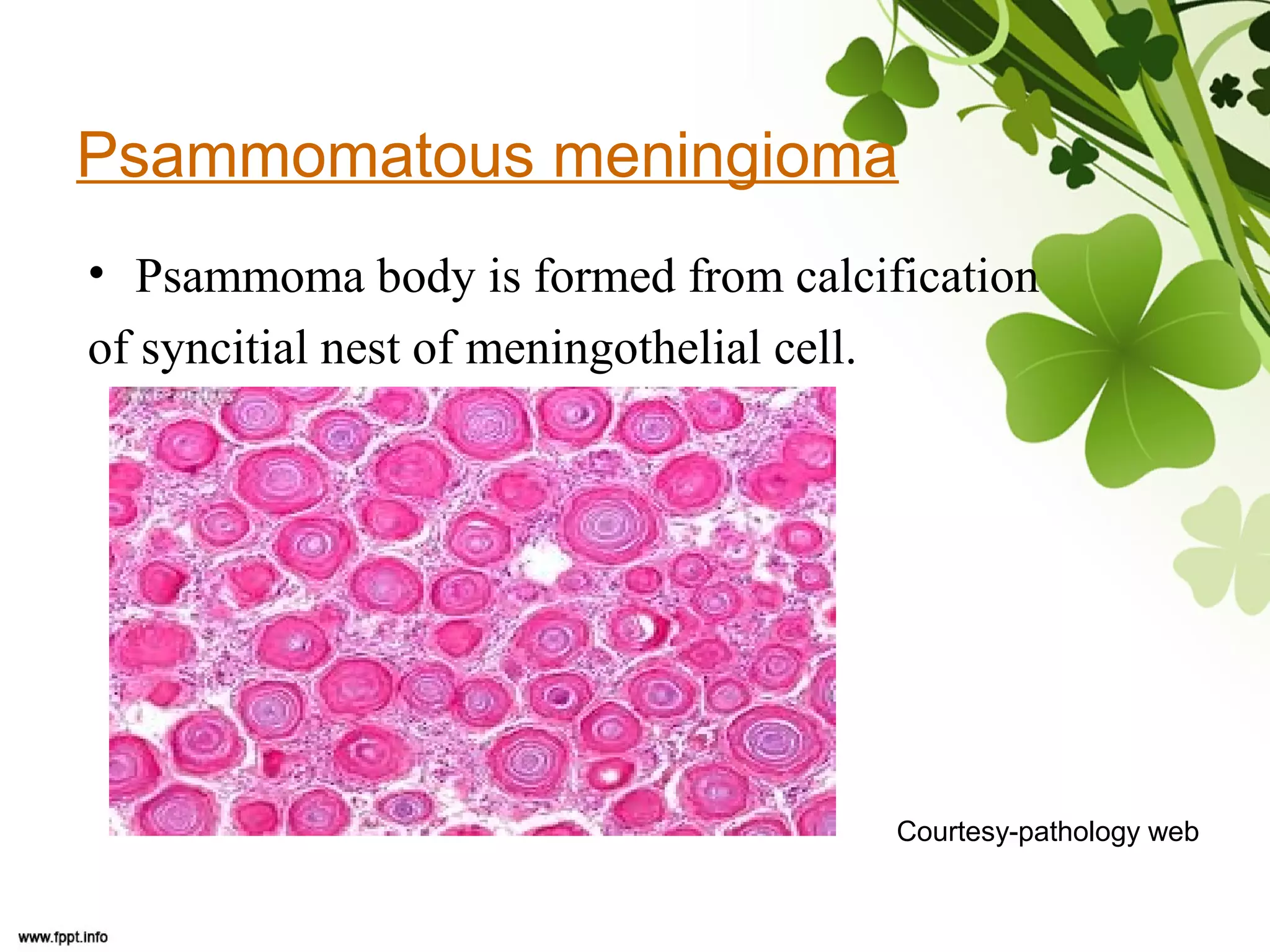 Psammomatous meningioma
• Psammoma body is formed from calcification
of syncitial nest of meningothelial cell.
Courtesy-pathology web