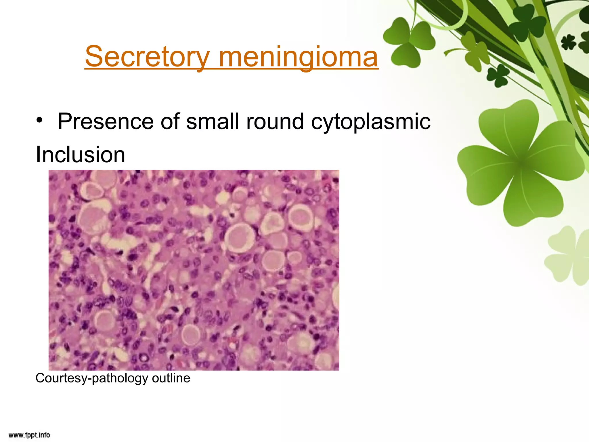 Secretory meningioma
• Presence of small round cytoplasmic
Inclusion
Courtesy-pathology outline
