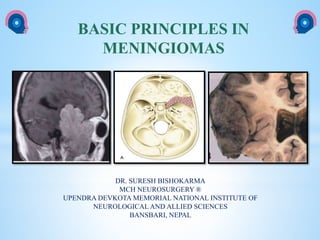 cka
BASIC PRINCIPLES IN
MENINGIOMAS
DR. SURESH BISHOKARMA
MCH NEUROSURGERY ®
UPENDRA DEVKOTA MEMORIAL NATIONAL INSTITUTE OF
NEUROLOGICAL AND ALLIED SCIENCES
BANSBARI, NEPAL
 