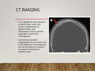 CT IMAGING
• CT is valuable for the detection
of calcifi cation within the
tumour, hyperostosis of
adjacent bone, and
intraosseous tumour growth,
especially in skull-base
meningiomas.
• Conventional cerebral
angiography has no routine role
in the diagnosis of meningioma,
but can be used as an adjunct
to treatment planning in
selected cases.
• CT imaging showing hyper
ostosis
 