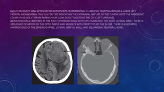 (A) A THIN RIM OF LOW ATTENUATION REPRESENTS CEREBROSPINAL FLUID (CSF) TRAPPED AROUND A LARGE LEFT
FRONTAL MENINGIOMA. THIS IS A FEATURE INDICATING THE EXTRAAXIAL NATURE OF THE TUMOR. NOTE THE VASOGENIC
EDEMA IN ADJACENT BRAIN PARENCHYMA (LOW DENSITY) OUTSIDE THE CSF CLEFT (ARROWS).
(B) MENINGIOMA CENTERED IN THE RIGHT SPHENOID WING WITH EXTENSION INTO THE RIGHT LATERAL ORBIT. THERE IS
RESULTANT DEVIATION OF THE OPTIC NERVE AND MUSCLES WITH PROPTOSIS OF THE GLOBE. THERE IS ASSOCIATED
HYPEROSTOSIS OF THE SPHENOID WING, LATERAL ORBITAL WALL, AND SQUAMOSAL TEMPORAL BONE.
 
