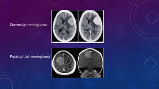 Convexity meningioma
Parasagittal meningioma
 