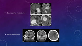 • Sphenoid wing meningioma
• Falcine meningioma
 