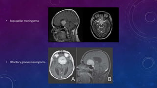 • Suprasellar meningioma
• Olfactory groove meningioma
 