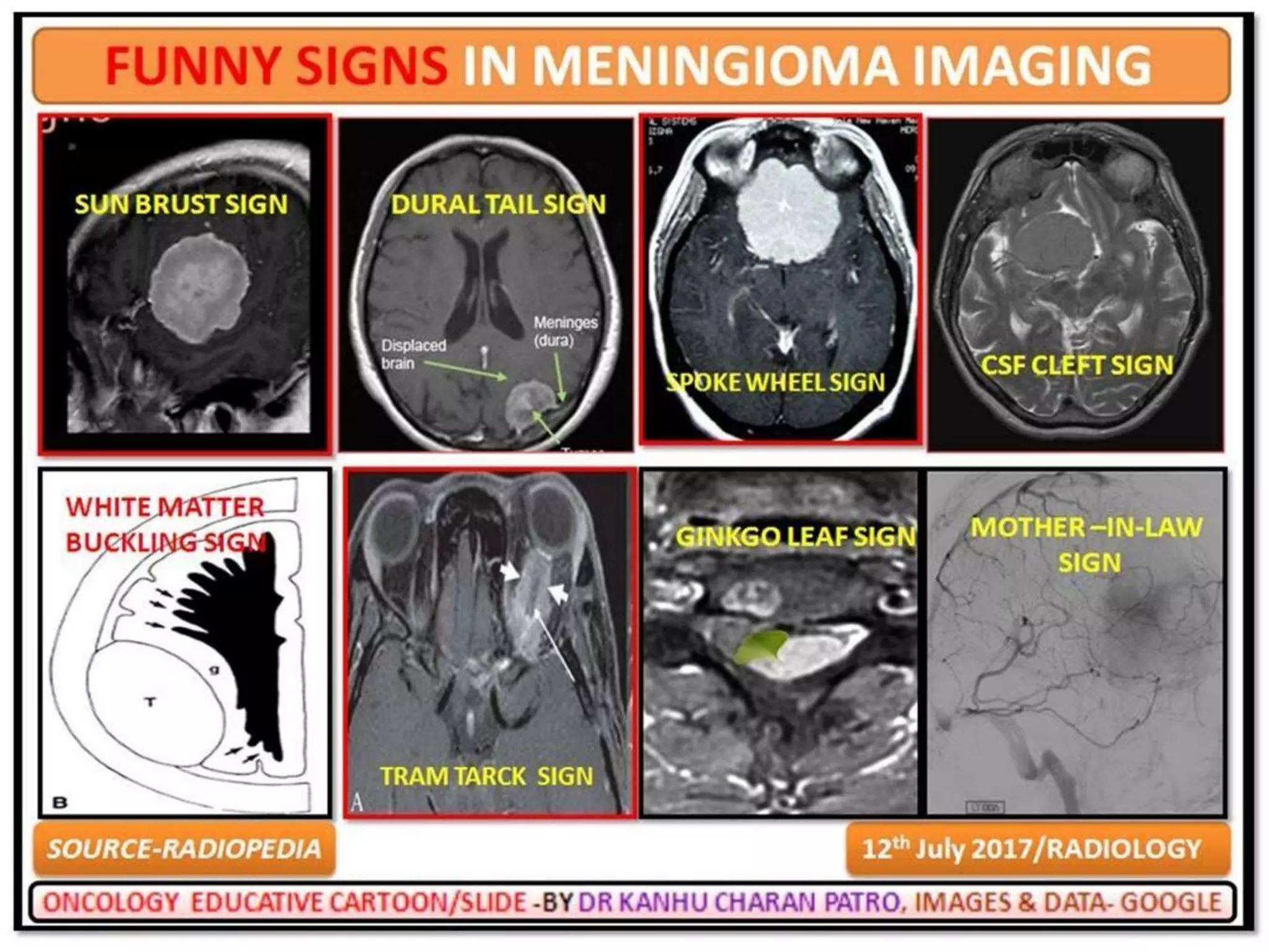 MANAGEMENT OF MENINGIOMA PPTX Cancer Diseases and Conditions