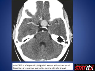 Axial CECT in a 26-year-old pregnant woman with sudden visual
loss shows an enhancing suprasellar mass (white solid arrow).
 