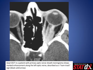 Axial CECT in a patient with primary optic nerve sheath meningioma shows
marked enhancement along the left optic nerve, described as a "tram-track"
sign (black solid arrow).
 