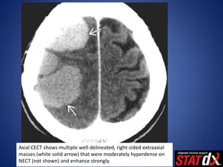 Axial CECT shows multiple well-delineated, right-sided extraaxial
masses (white solid arrow) that were moderately hyperdense on
NECT (not shown) and enhance strongly.
 