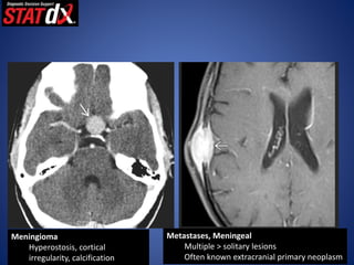 •
Meningioma
Hyperostosis, cortical
irregularity, calcification
Metastases, Meningeal
Multiple > solitary lesions
Often known extracranial primary neoplasm
 
