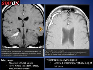 Tuberculosis
• Abnormal CXR, lab values
• Travel history to endemic areas,
immunocompromised
Hypertrophic Pachymeningitis
• localised inflammatory thickening of
the dura
 