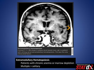Extramedullary Hematopoiesis
Patients with chronic anemia or marrow depletion
Multiple > solitary
 