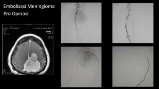 Embolisasi Transarterial Embolization of Meningiomas | PPTX