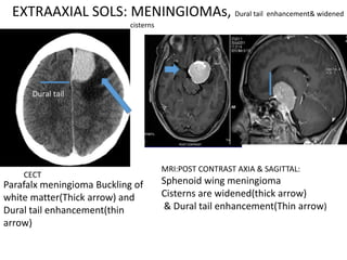 Parafalx meningioma Buckling of
white matter(Thick arrow) and
Dural tail enhancement(thin
arrow)
Dural tail
CECT
MRI:POST CONTRAST AXIA & SAGITTAL:
Sphenoid wing meningioma
Cisterns are widened(thick arrow)
& Dural tail enhancement(Thin arrow)
EXTRAAXIAL SOLS: MENINGIOMAs, Dural tail enhancement& widened
cisterns
 