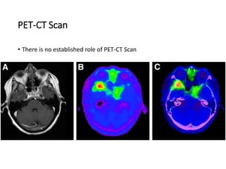 PET-CT Scan
• There is no established role of PET-CT Scan
 