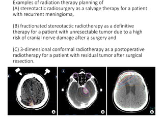 Examples of radiation therapy planning of
(A) stereotactic radiosurgery as a salvage therapy for a patient
with recurrent meningioma,
(B) fractionated stereotactic radiotherapy as a definitive
therapy for a patient with unresectable tumor due to a high
risk of cranial nerve damage after a surgery and
(C) 3-dimensional conformal radiotherapy as a postoperative
radiotherapy for a patient with residual tumor after surgical
resection.
 