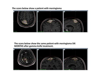 The scans below show a patient with meningioma
The scans below show the same patient with meningioma SIX
MONTHS after gamma knife treatment.
 