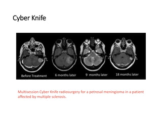 Cyber Knife
Multisession Cyber Knife radiosurgery for a petrosal meningioma in a patient
affected by multiple sclerosis.
 