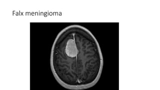 Falx meningioma
 