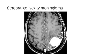Cerebral convexity meningioma
 