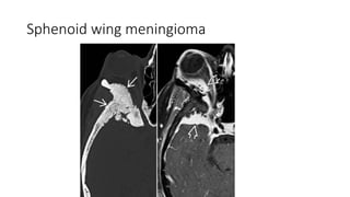Sphenoid wing meningioma
 