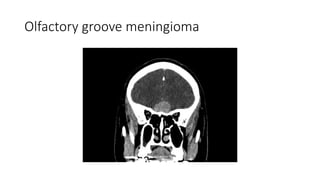 Olfactory groove meningioma
 