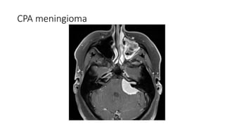 CPA meningioma
 