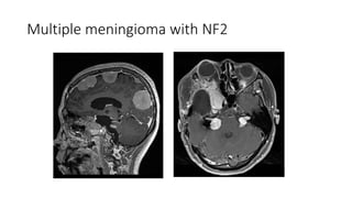 Multiple meningioma with NF2
 