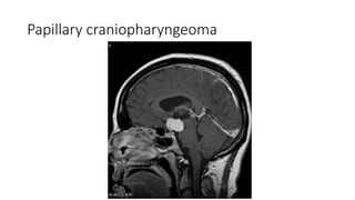 Papillary craniopharyngeoma
 