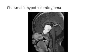 Chaismatic-hypothalamic gioma
 