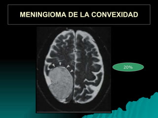 MENINGIOMA DE LA CONVEXIDAD 20%