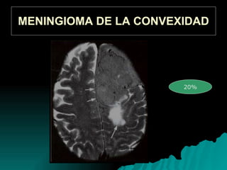MENINGIOMA DE LA CONVEXIDAD 20%