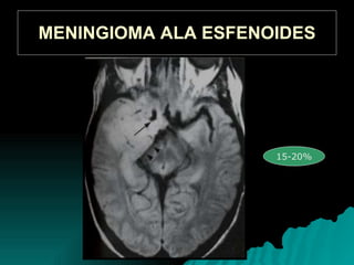 MENINGIOMA ALA ESFENOIDES 15-20%
