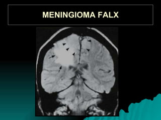 MENINGIOMA FALX
