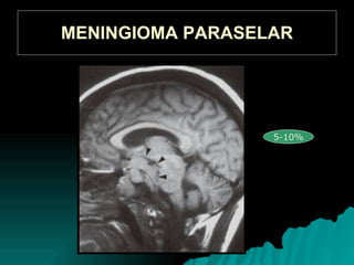MENINGIOMA PARASELAR 5-10%
