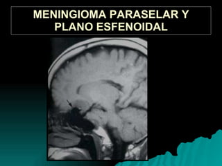 MENINGIOMA PARASELAR Y PLANO ESFENOIDAL