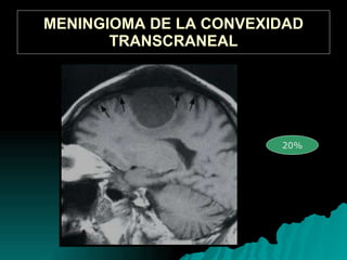 MENINGIOMA DE LA CONVEXIDAD TRANSCRANEAL 20%