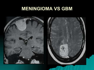 MENINGIOMA VS GBM