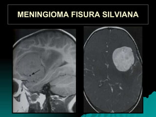 MENINGIOMA FISURA SILVIANA