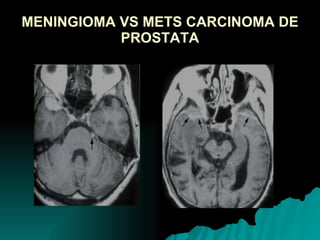 MENINGIOMA VS METS CARCINOMA DE PROSTATA 