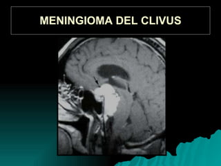 MENINGIOMA DEL CLIVUS