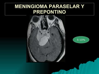 MENINGIOMA PARASELAR Y PREPONTINO 5-10%