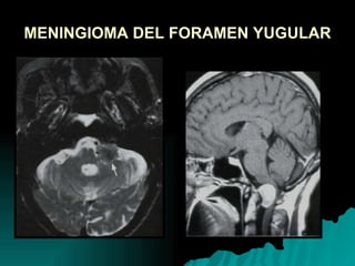 MENINGIOMA DEL FORAMEN YUGULAR