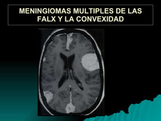 MENINGIOMAS MULTIPLES DE LAS FALX Y LA CONVEXIDAD