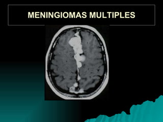 MENINGIOMAS MULTIPLES